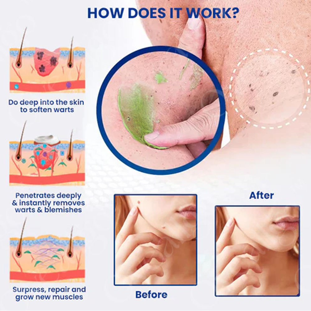 Fivfivgo™ NatureErase Instant Mole & Spot Removal Gel