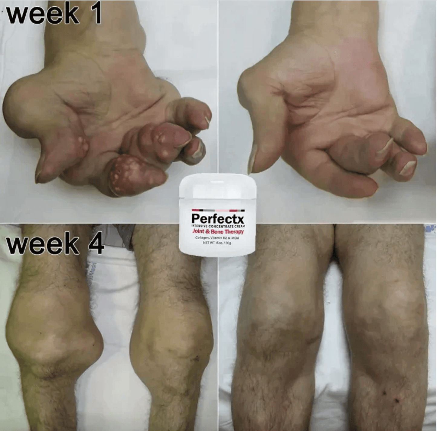 كريم GFOUK™ Perfectx لعلاج المفاصل والعظام