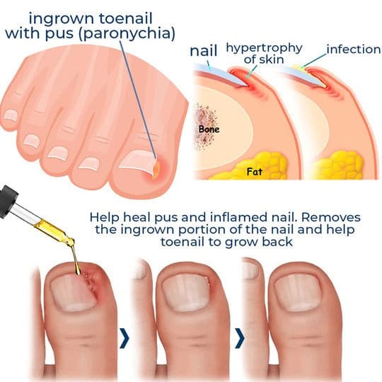German ToenailPlus™ Anti-Paronychia Relief Oil - flowerence