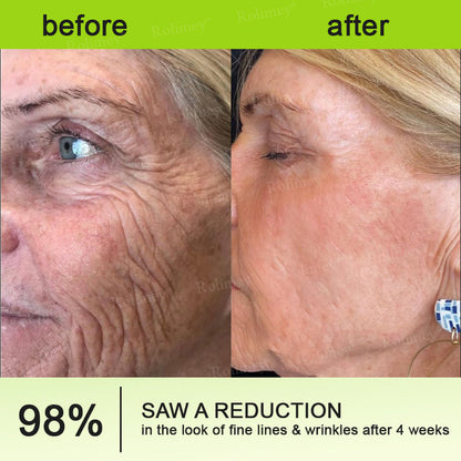 ⏰ Last Day! 70% OFF 💫 Rolimey® Botox & Vita-A Retinol Wrinkle-Lift Cream – Made & Shipped from Australia 🌟👨‍⚕️