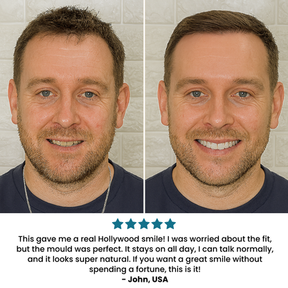 The AuraSmile Veneers - Perfect Smile in 5 Minutes, Dentist-Free Results, and Confidence Boost + 50% OFF