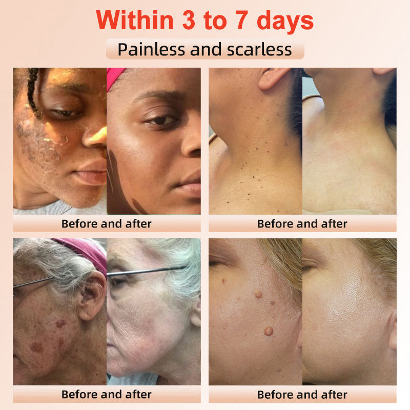 Purifying Exfoliating Gel for Acanthosis Nigricans, Exfoliation, Dark Spots, Skin Tags, and Eczema