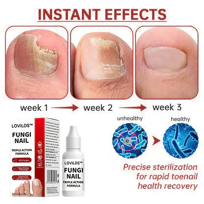 FungaClear Triple-Action Nail Repair - Clear Nails, Renewed Confidence + 1+1 FREE