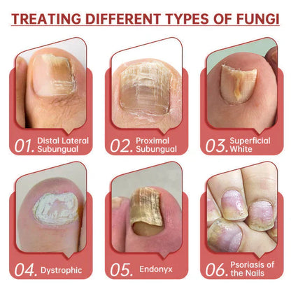 FungaClear Triple-Action Nail Repair - Clear Nails, Renewed Confidence + 1+1 FREE