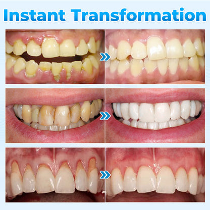 MicroSmile - Reverse Gum Recession. + 50% OFF