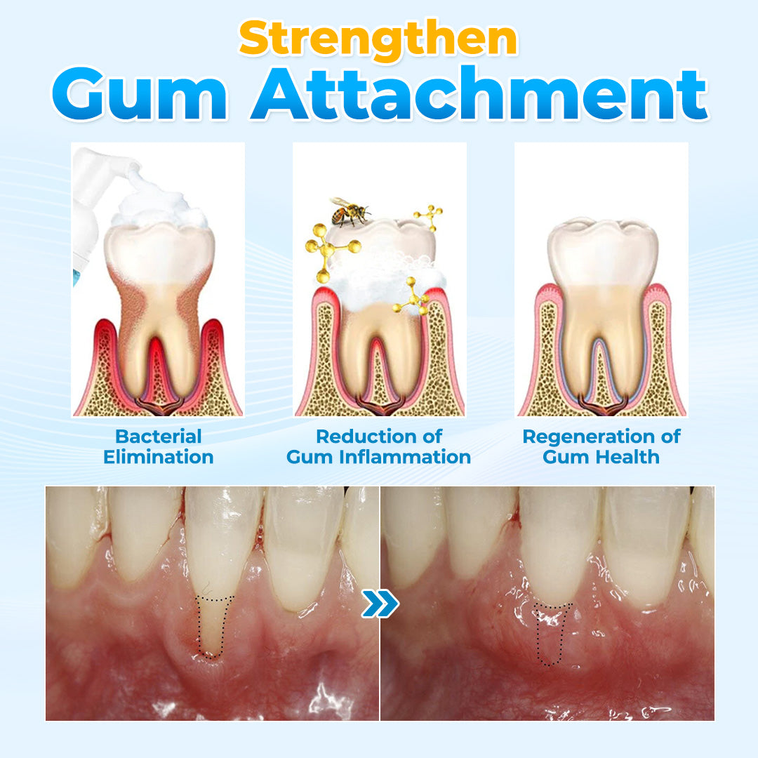 MicroSmile - Reverse Gum Recession. + 50% OFF