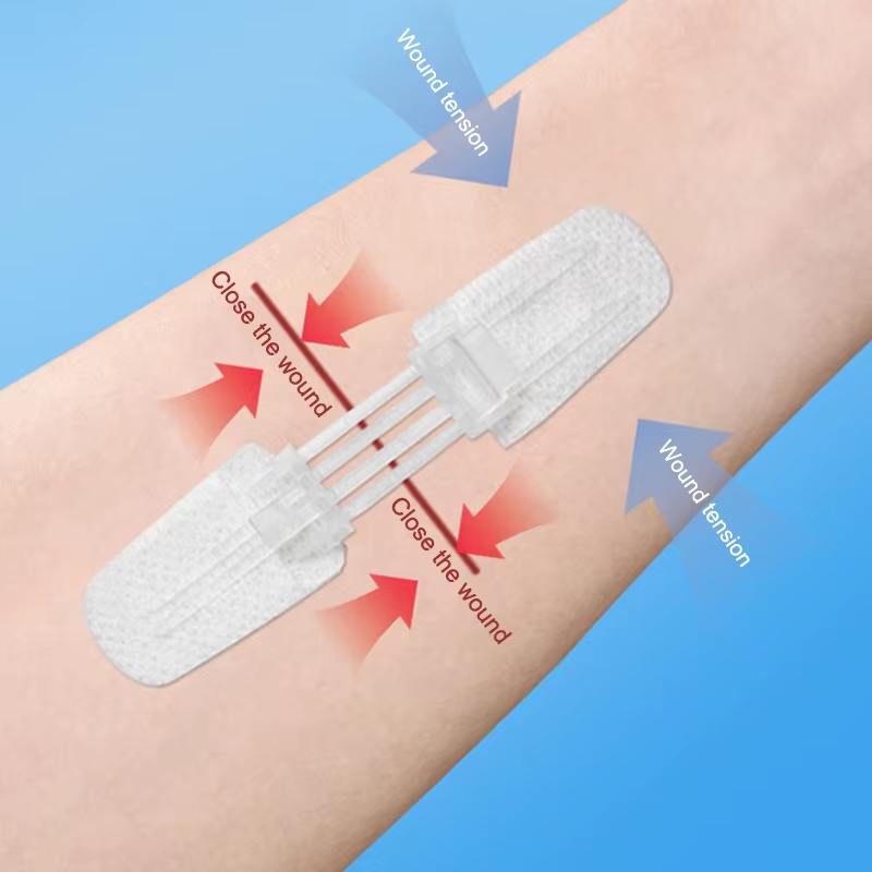 ZipSeal™ Closure Kit